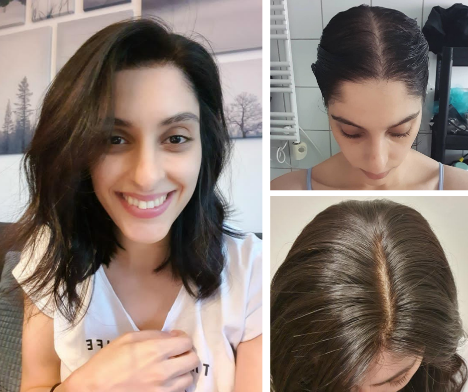 Types of Hair Patch Services in Delhi